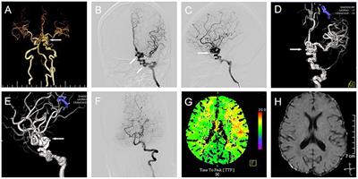 Cerebral Revascularization for the Management of Symptomatic Pure Arterial Malformations